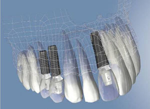 udemax implantes