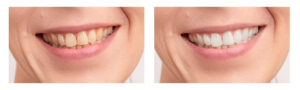 Dientes amarillos tras blanqueamiento