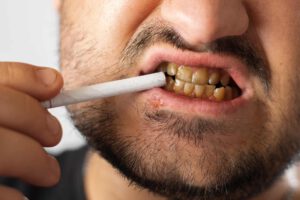 Dientes amarillos: causas, soluciones y tratamientos profesionales en Mallorca