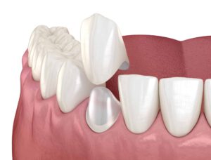 Corona dental sobre diente