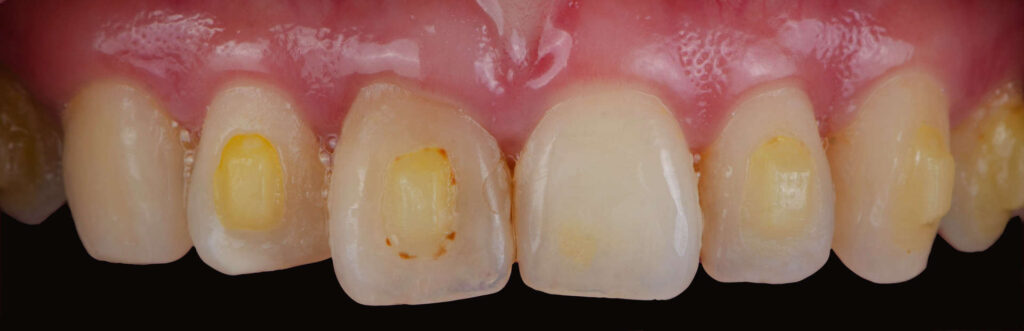Stains on milk teeth