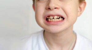 Manchas en los dientes de leche: causas, tipos y tratamiento en Mallorca