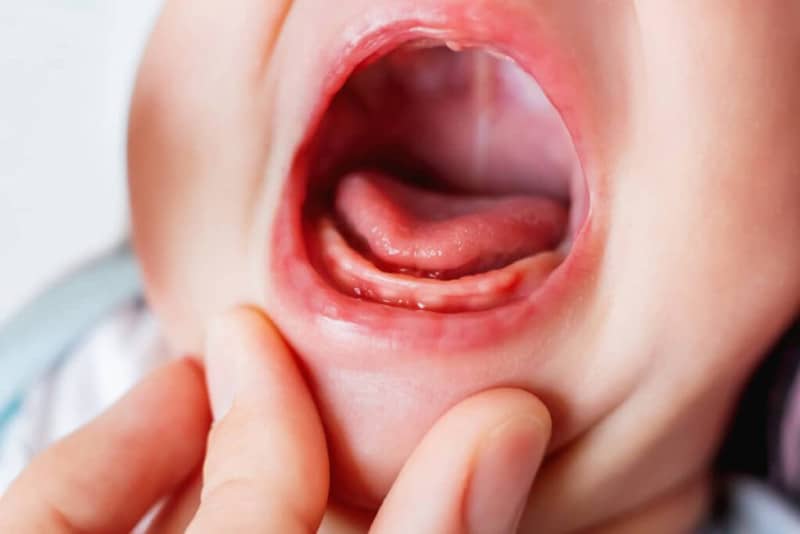 encías inflamadas bebé
