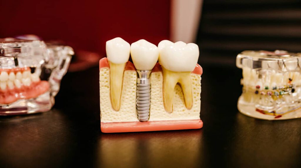 Primer plano de una corona dental de cerámica colocada sobre un modelo de arcada dental, mostrando dientes de aspecto natural. La imagen destaca la estética y la funcionalidad de la prótesis, que simula la forma y el color de los dientes reales.