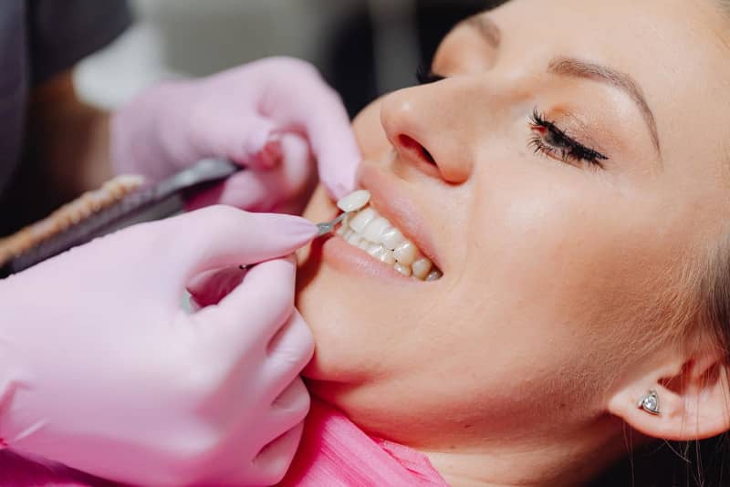 cuidado de las carillas dentales