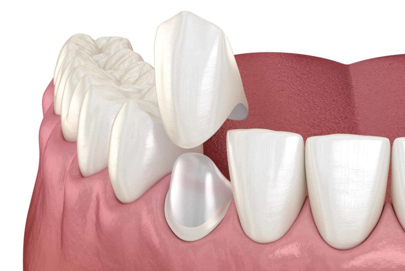 Corona dental sobre diente