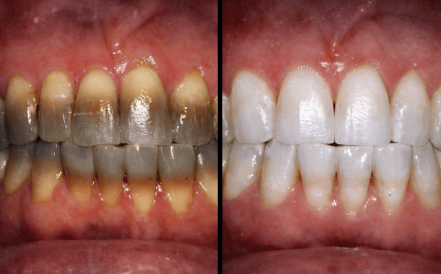 tetracyclines Teeth stains